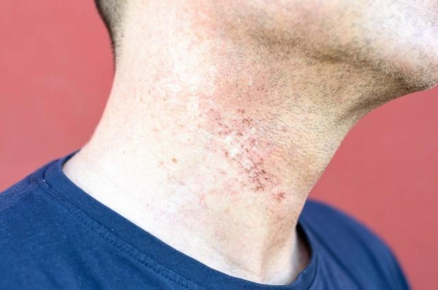生病可能不是坏事提醒:5种病不吃kaiyun开云网站药可能让你更健康(图3)